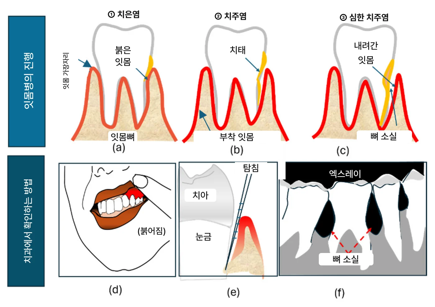 잇몸에서 피가 날 때 칫솔질과 관리법 총정리