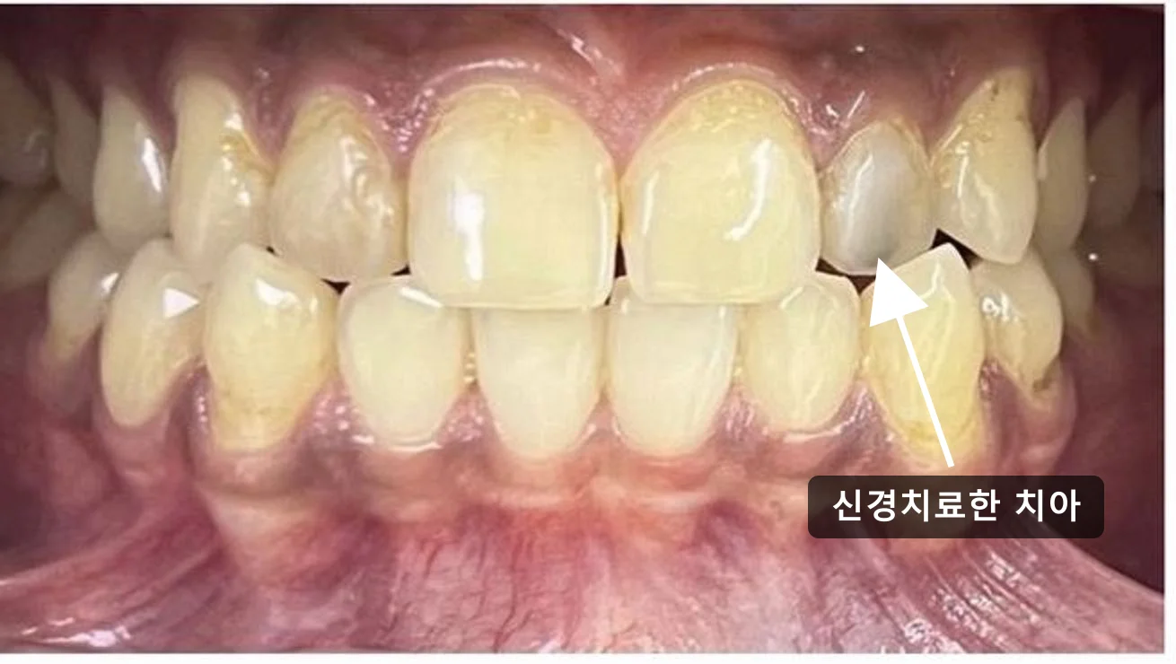 신경치료한 앞니가 점점 어두워질 때, 미백으로 될지 덮어야 할지는 어떻게 판단하나요?