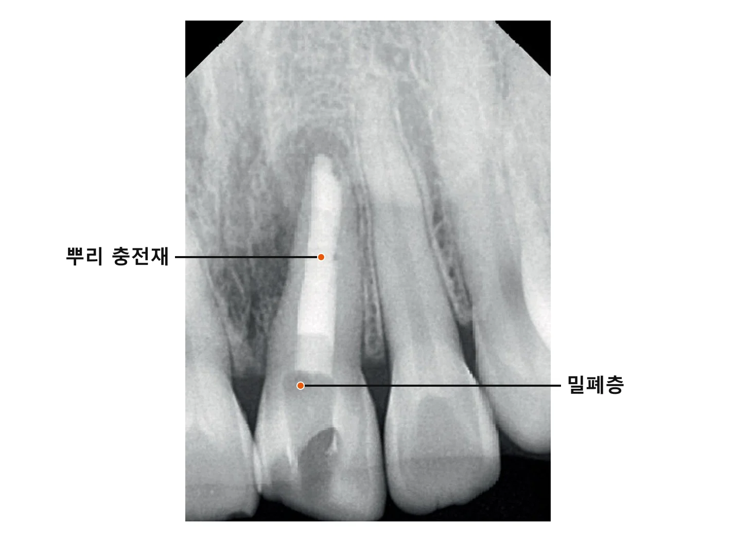 신경치료한 위 앞니의 치근단 X-ray. 뿌리 안이 하얗게 보이는 뿌리 충전재로 채워져 있고, 그 위 치아 목 부분에 밀폐층이 올라가 있다. 「뿌리 충전재」「밀폐층」 표시가 각각을 가리킨다