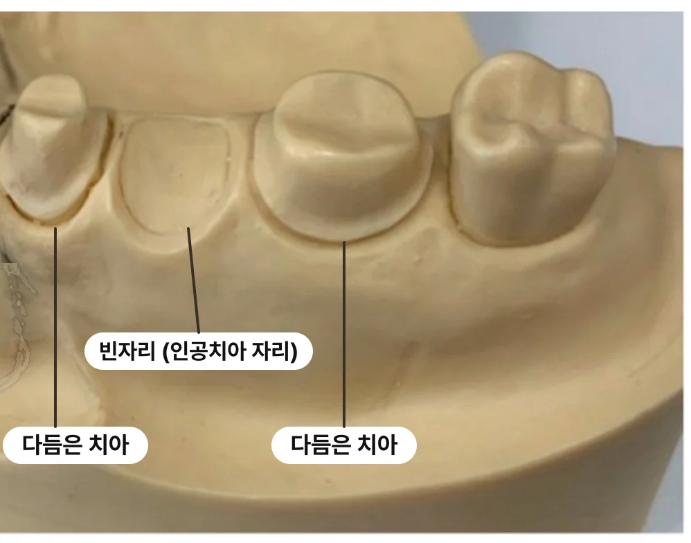 임플란트 말고 다른 방법은 없나요?