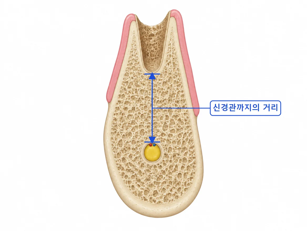 뽑은 직후 빈 자리의 아래턱 소구치 부위 단면, 뼈 중간 높이까지 덮은 잇몸, 뿌리 끝 아래 남은 뼈와 신경이 채운 신경관, 발치와 바닥에서 신경관까지의 거리 표시