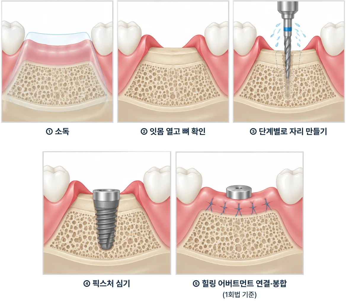 임플란트 수술 날, 실제로 무엇을 하고 얼마나 걸리나요?