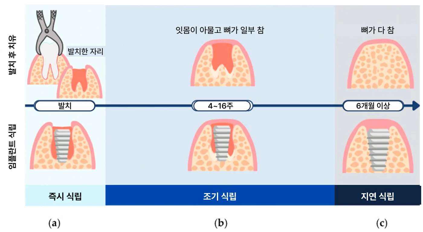 임플란트, 왜 사람마다 기간이 다른가요?