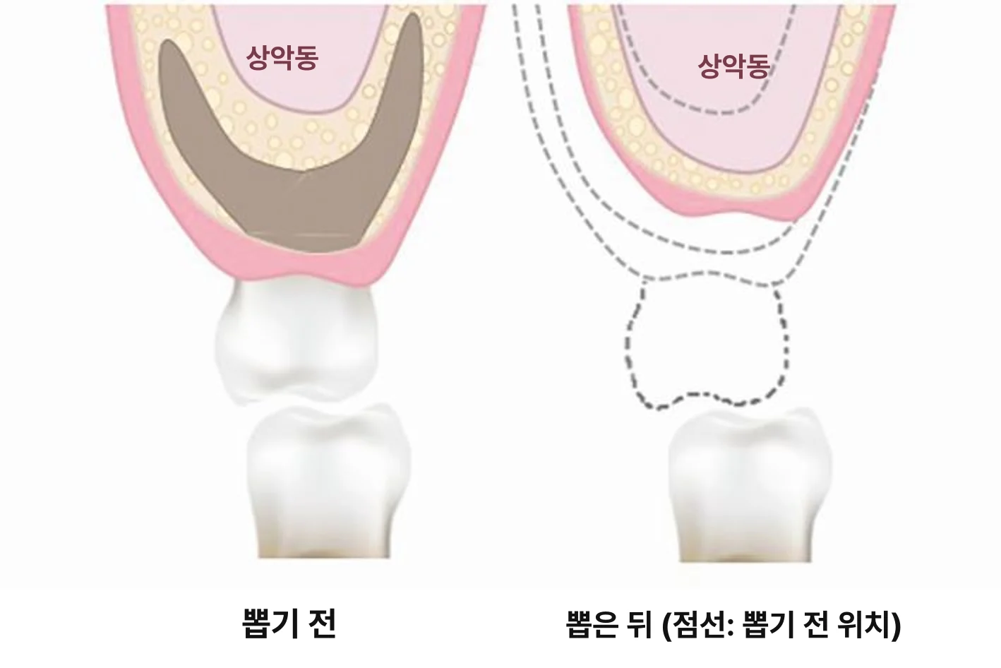 뼈가 없어서 임플란트가 안 된다고 들었는데, 정말 방법이 없나요?