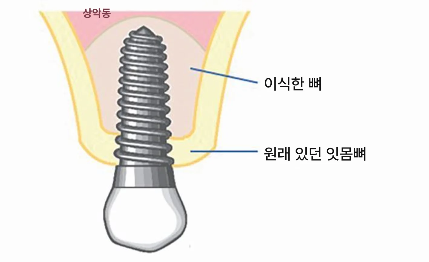 상악동 거상술 뒤 임플란트를 세로로 자른 그림. 임플란트 아래쪽은 원래 있던 잇몸뼈(노란색)에 박혀 있고, 위쪽은 상악동 점막을 들어 올린 자리에 채운 이식한 뼈(연분홍색) 안에 있다. 그 위로 상악동(분홍색)이 남아 있다