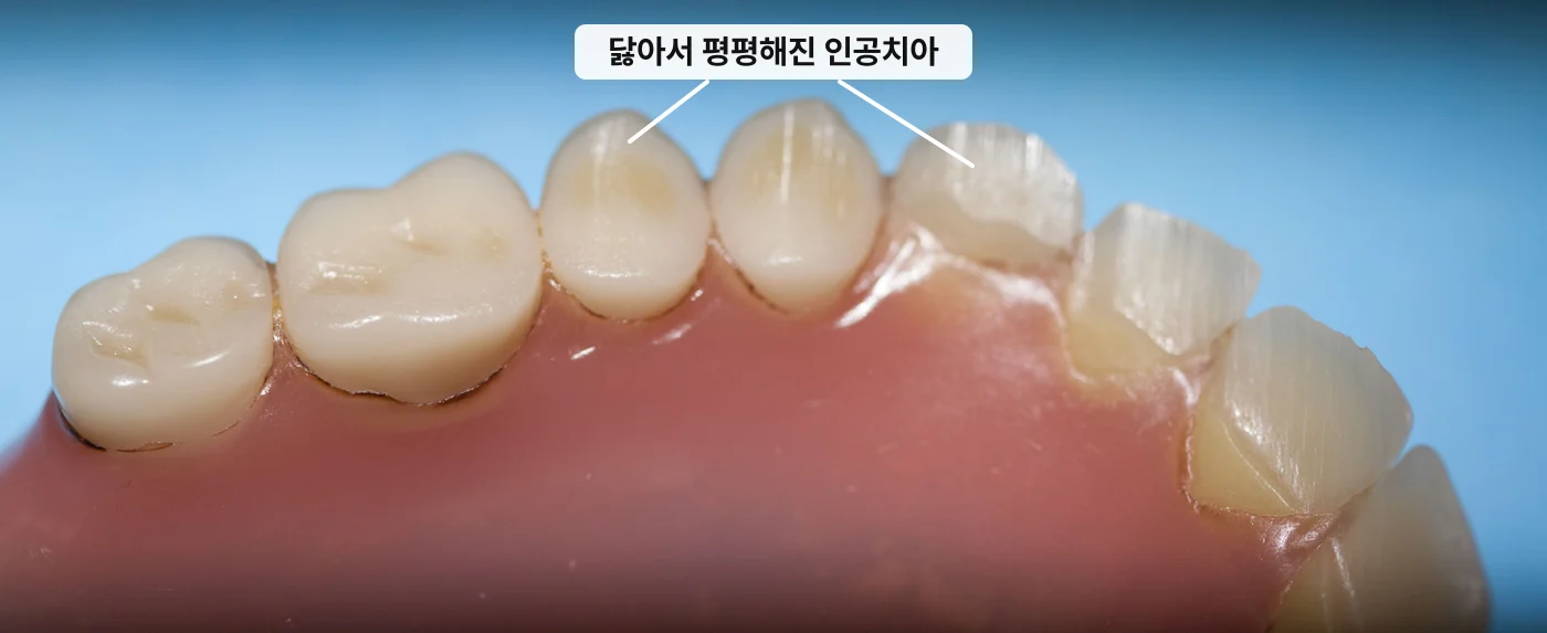 틀니가 자꾸 흔들릴 때 확인해야 할 것들