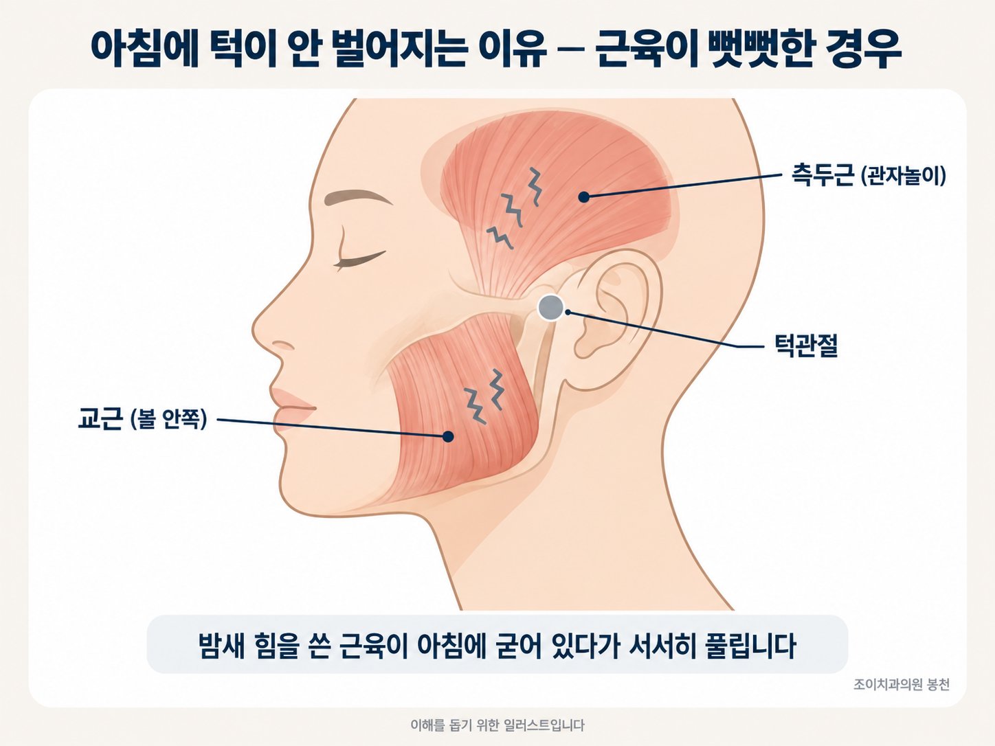 아침에 일어났을 때 턱이 잘 안 벌어진다고요?