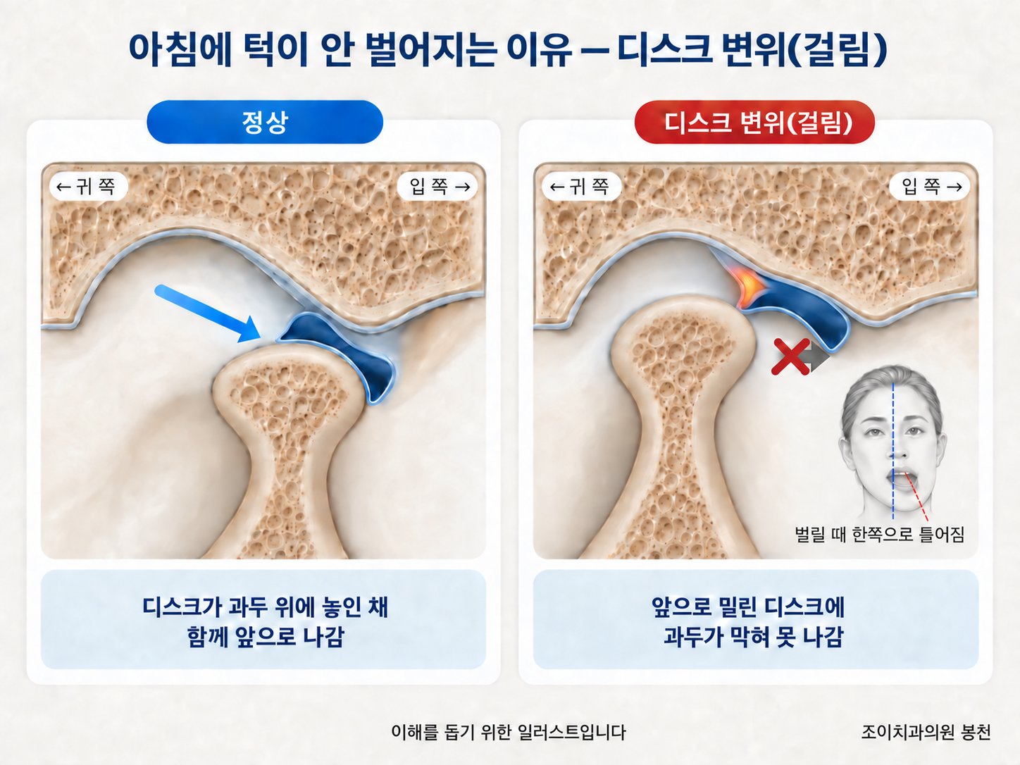 정상 턱관절과 디스크 변위(걸림)의 비교 도해 — 왼쪽 정상은 디스크가 과두 위에 놓인 채 함께 앞으로 나가고, 오른쪽 변위는 앞으로 밀린 디스크에 과두가 막혀 못 나가며, 입을 벌릴 때 아래턱이 한쪽으로 틀어짐