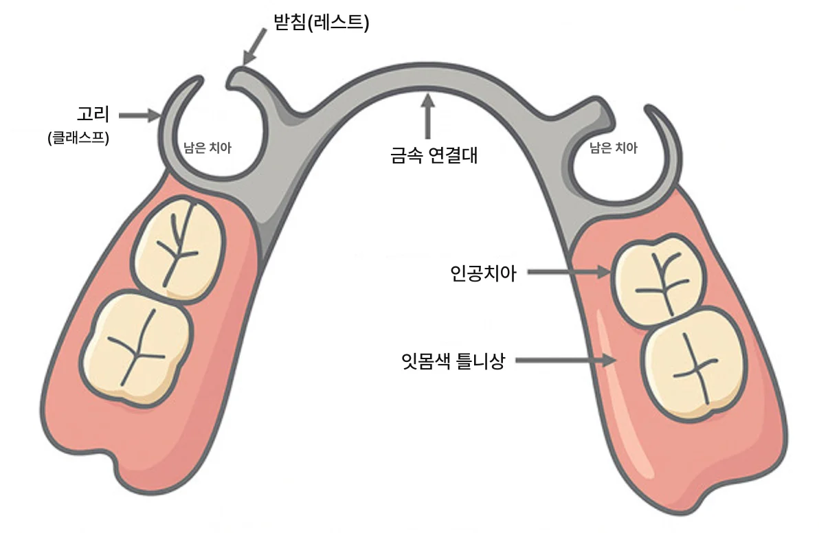 부분틀니의 구성 요소를 위에서 본 도식. 양쪽 남은 치아 자리를 감싸는 고리(클래스프), 고리 옆에서 남은 치아 위에 걸치는 받침(레스트), 양쪽을 잇는 금속 연결대, 빠진 자리를 채우는 인공치아와 이를 받치는 잇몸색 틀니상이 화살표로 표시되어 있다