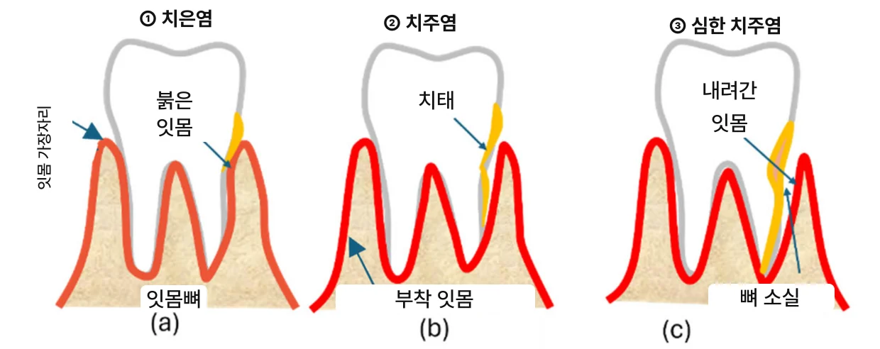 스케일링, 왜 6개월마다 받으라고 할까요?