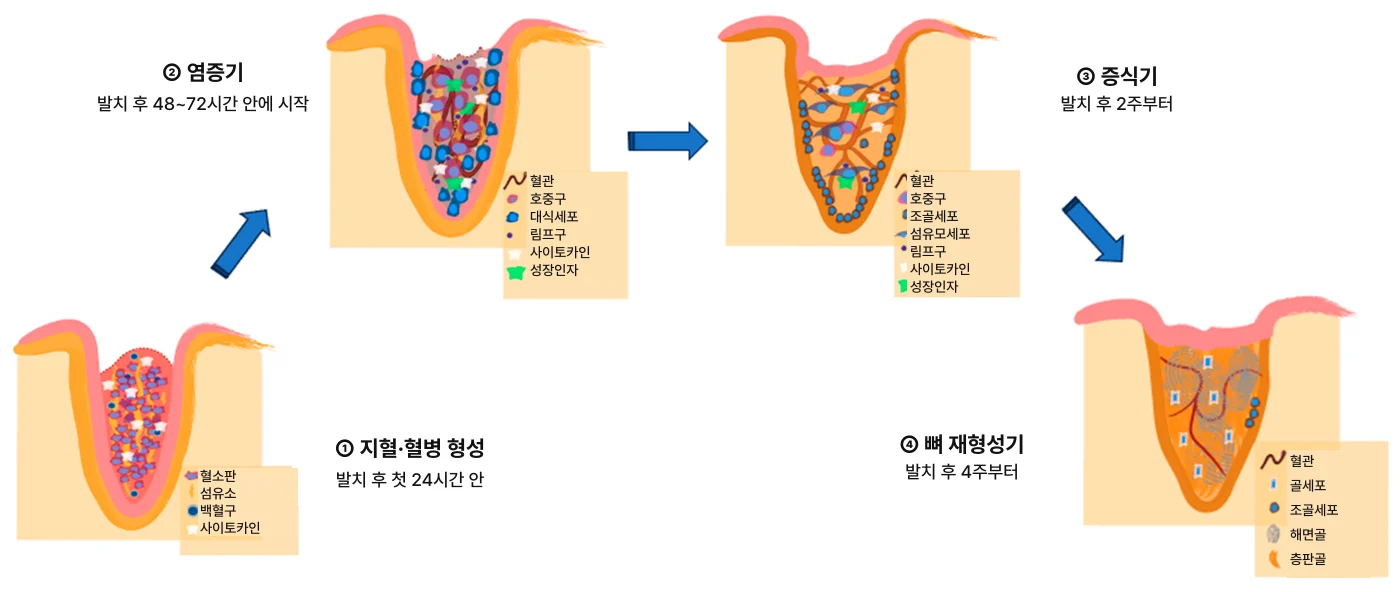 사랑니 발치 후 주의사항 — 당일 지혈부터 실밥 제거까지