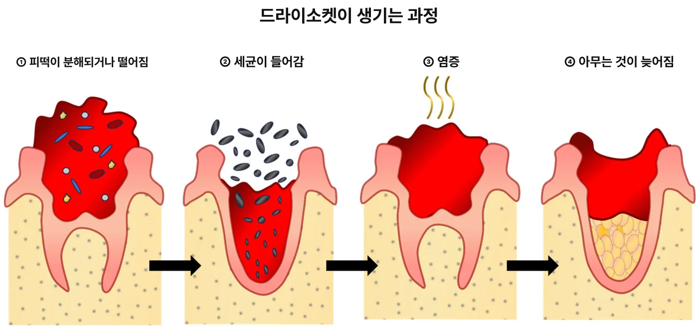 드라이소켓이 생기는 과정을 네 단계로 나타낸 도식. ① 피떡이 분해되거나 떨어짐, ② 검은 타원으로 표현한 세균이 들어감, ③ 염증, ④ 아무는 것이 늦어짐을 검은 화살표로 잇는다