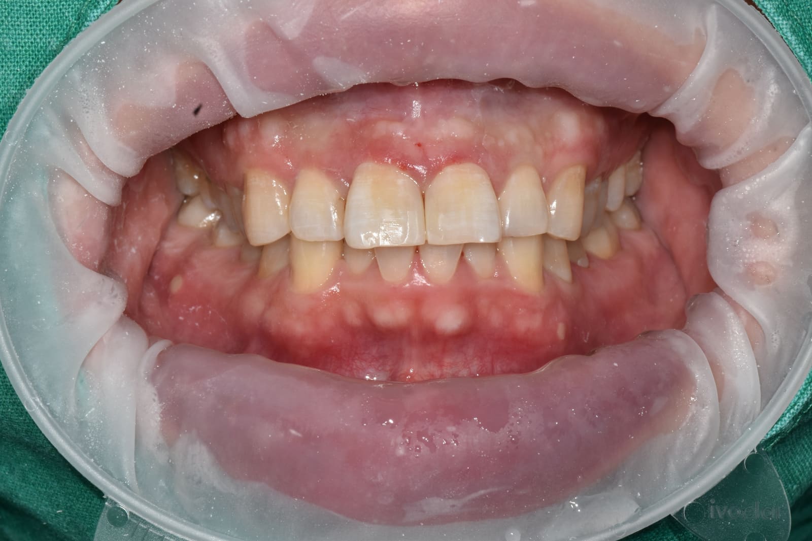 수복 후 — 좌우 대칭이 맞고 잇몸선과 조화를 이룬 정면 모습