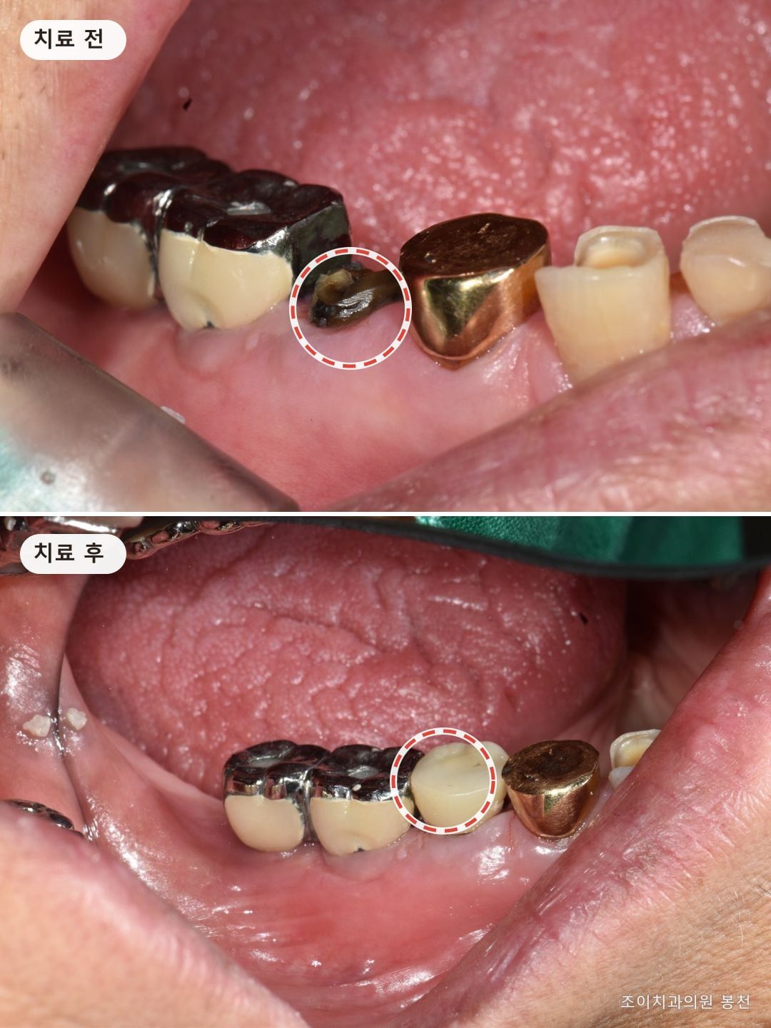 식사 중 부러진 작은어금니, 뽑아야 하나요? — 신경치료된 치아를 기둥과 크라운으로 살린 사례
