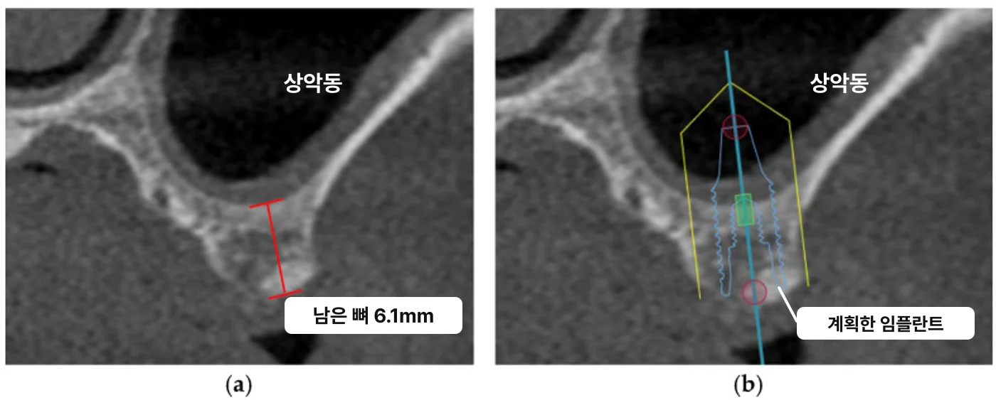 위 어금니 자리 CT 단면 두 장. (a)는 상악동 바닥 아래 남은 잇몸뼈 높이를 빨간 선으로 재어 6.1mm로 표시했고, (b)는 같은 자리에 계획한 임플란트 윤곽이 뼈를 넘어 상악동 안까지 들어가는 모습이다
