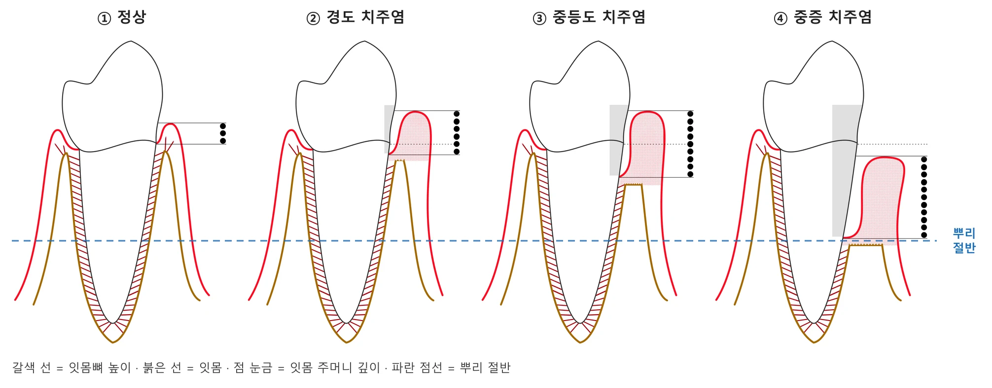 흔들리는 치아, 뽑기 전에 잇몸치료 3개월을 권하는 이유