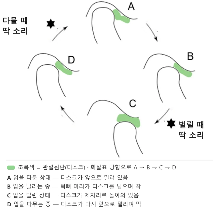 턱에서 소리 날 때, 해야 하는 것과 하지 말아야 할 것
